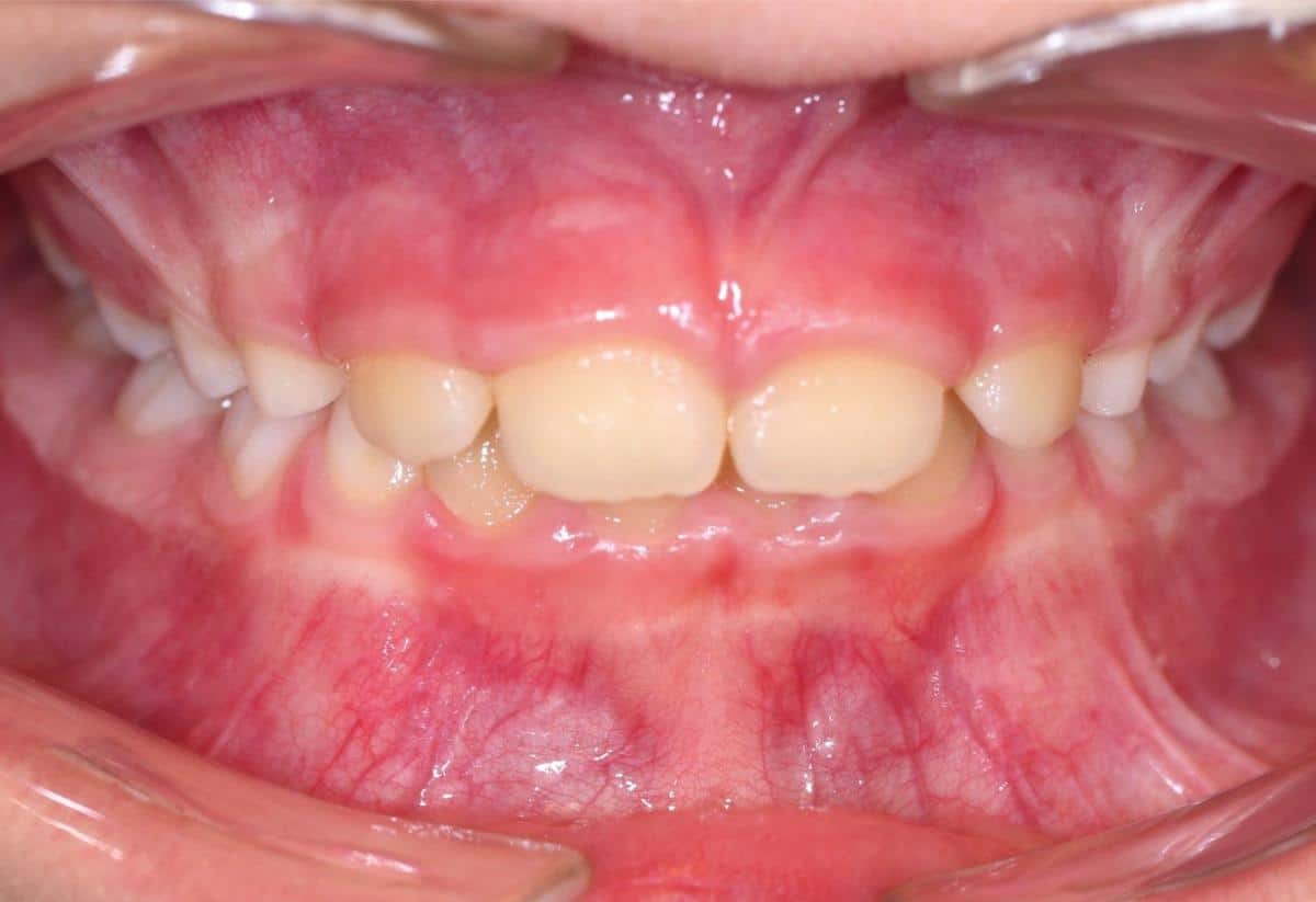Uso del ciuccio e malocclusioni dentali: cosa occorre sapere - Amico  Pediatra