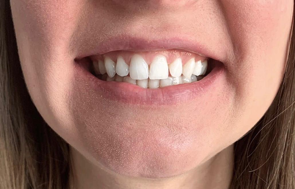 Teleconsulto ortodontico in videochiamata: come fare le foto alla propria bocca