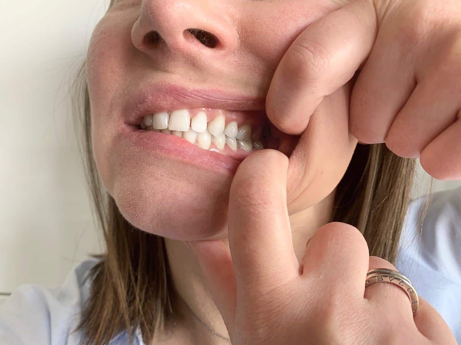 Teleconsulto ortodontico in videochiamata: come fare le foto alla propria bocca