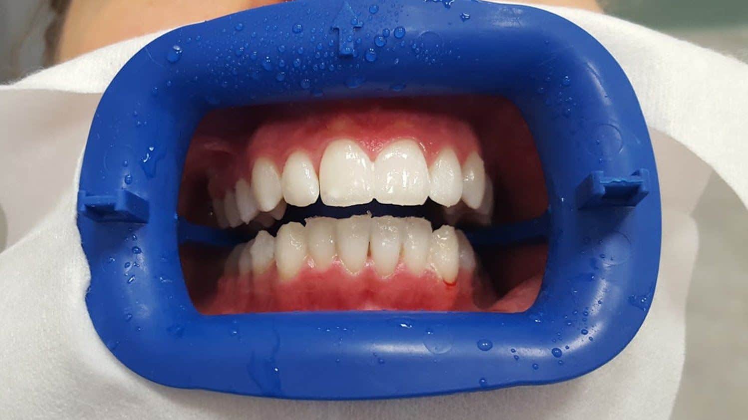 Sbiancamento dentale professionale per denti macchiati e ingialliti: scopri cause e soluzioni per le macchie sui denti