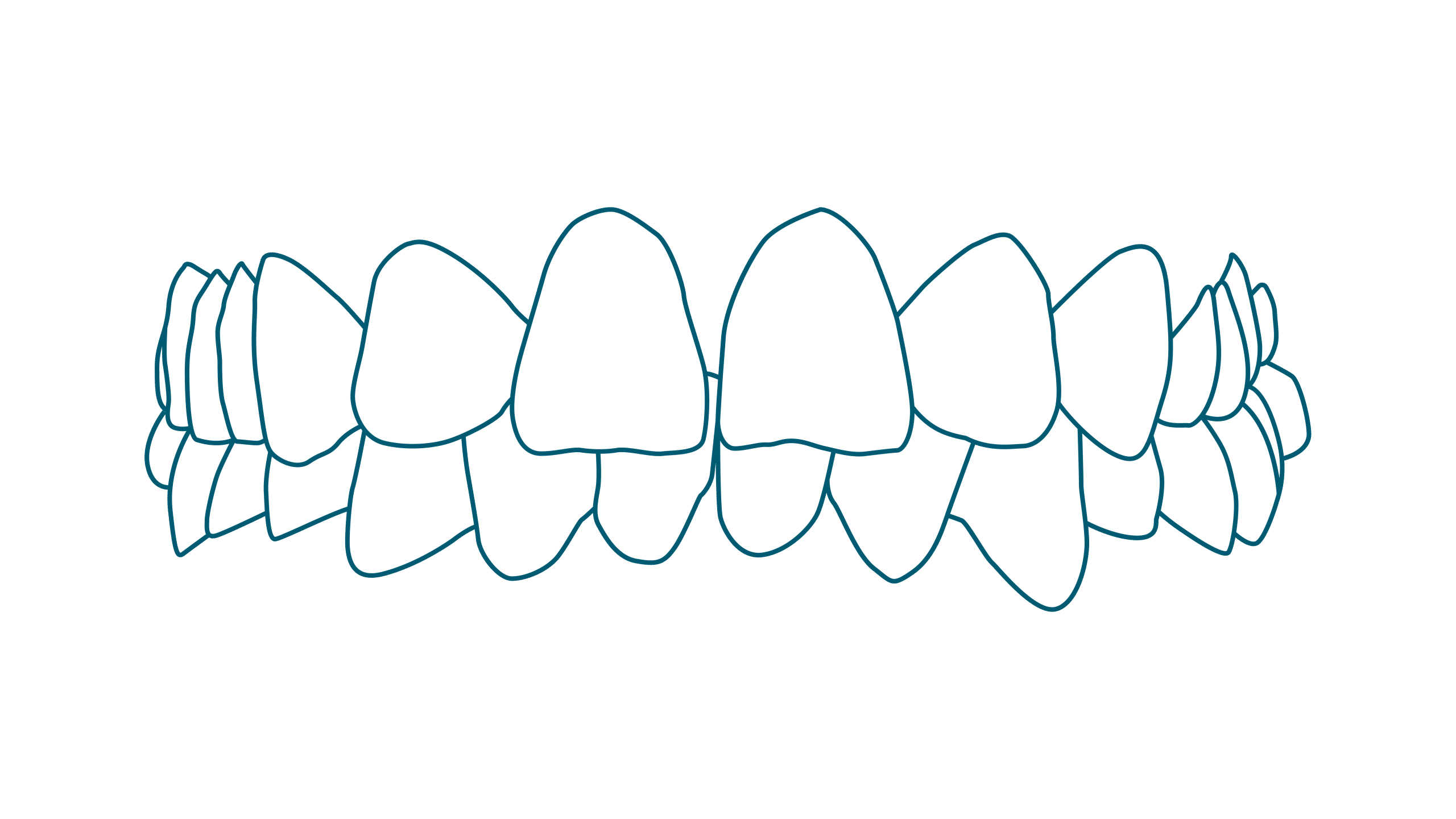 Ortodonzia trasparente