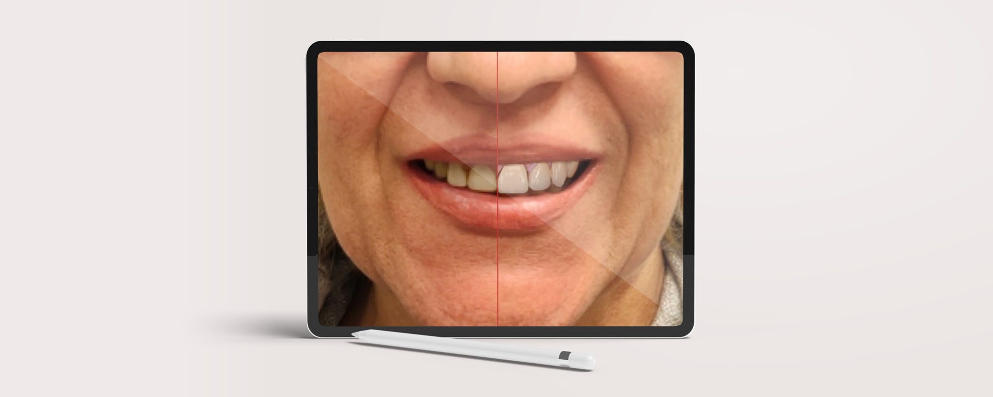 Faccette dentali estetiche: cosa aspettarsi dal trattamento con Smile Design negli studi Brush